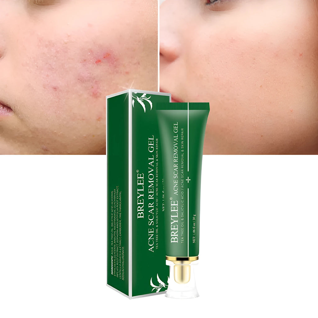 Green tube of acne scar removal gel with tea tree oil, 30g size on white background