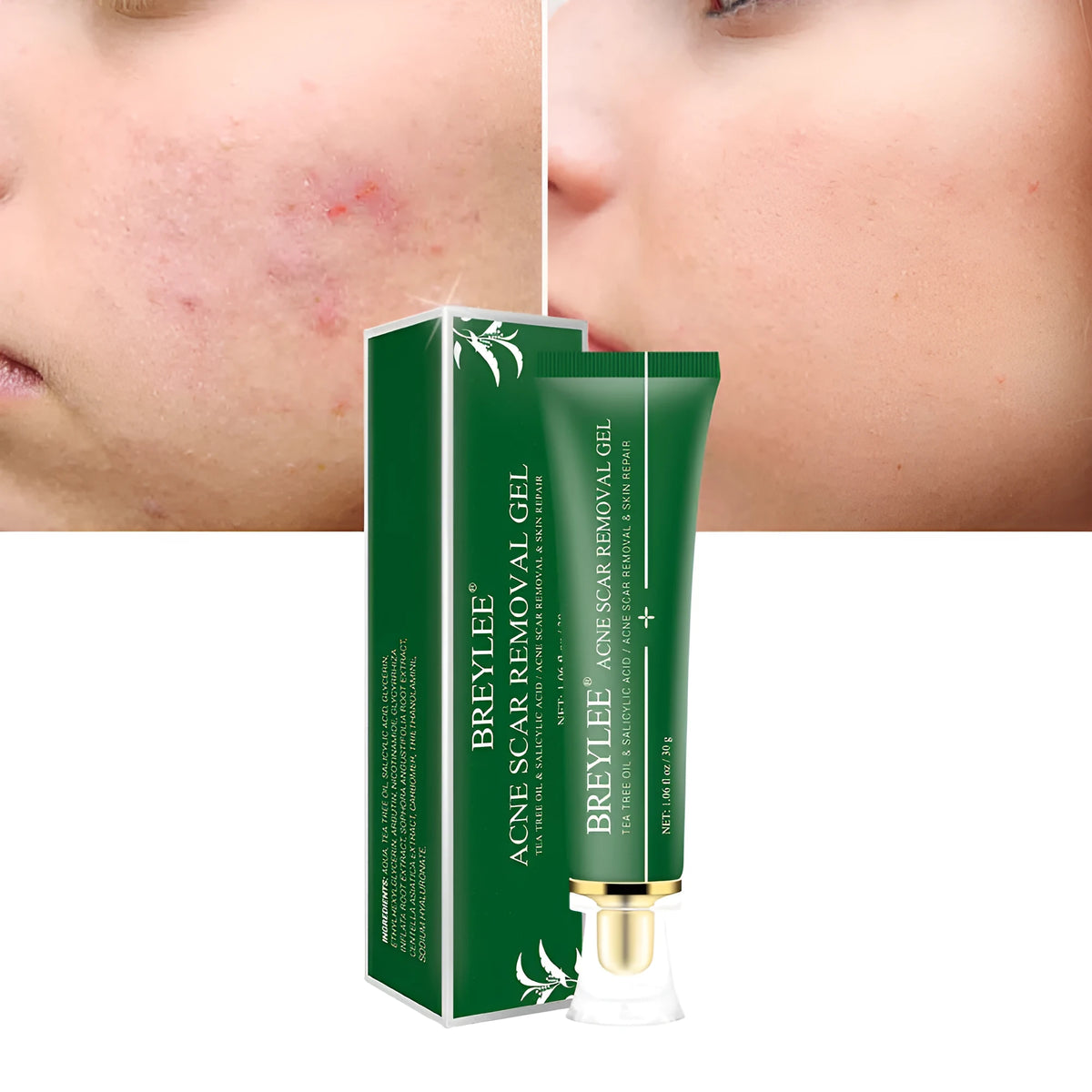 Green tube of acne scar removal gel with tea tree oil, 30g size on white background