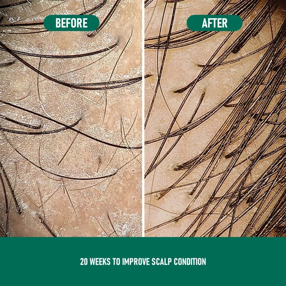 Can of CH004 Minoxidil 5% anti-hair loss mousse foam spray with applicator.