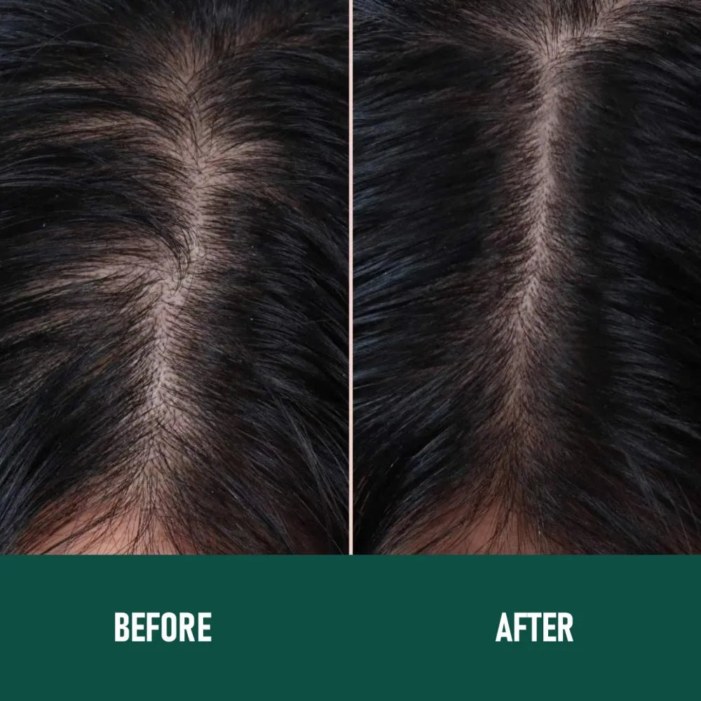 Can of CH004 Minoxidil 5% anti-hair loss mousse foam spray with applicator.