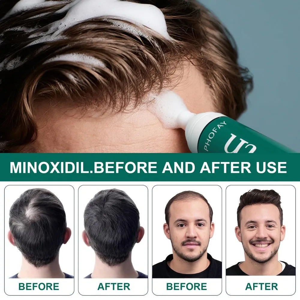 Can of CH004 Minoxidil 5% anti-hair loss mousse foam spray with applicator.