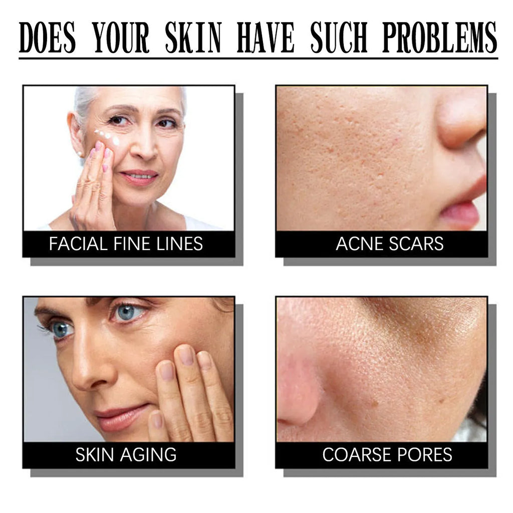 50g salicylic acid moisturising cream for exfoliation and smallpox treatment