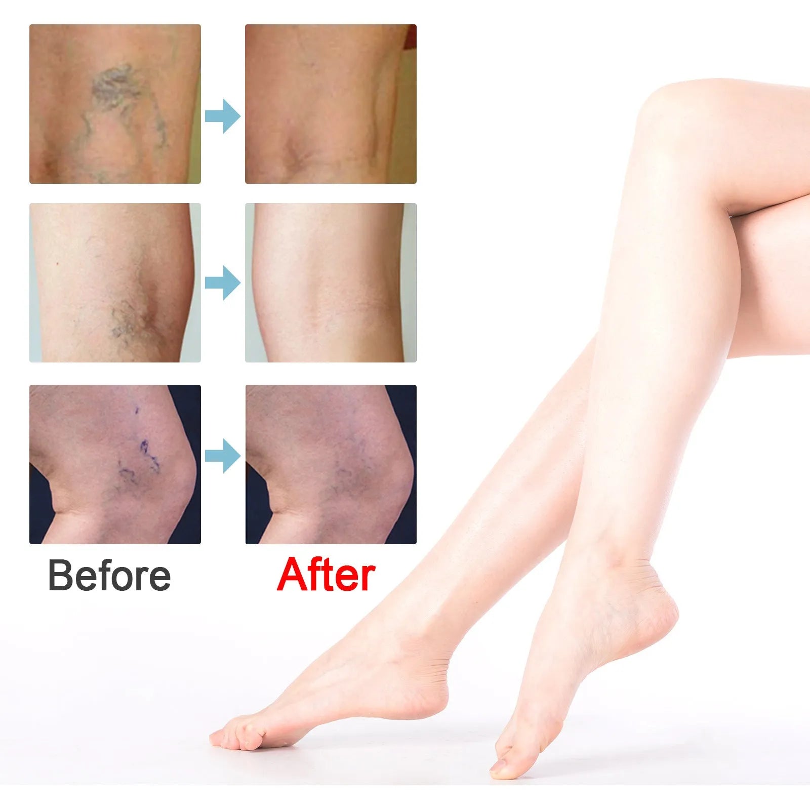 20g tube of vein repair cream for leg circulation and visible vein relief