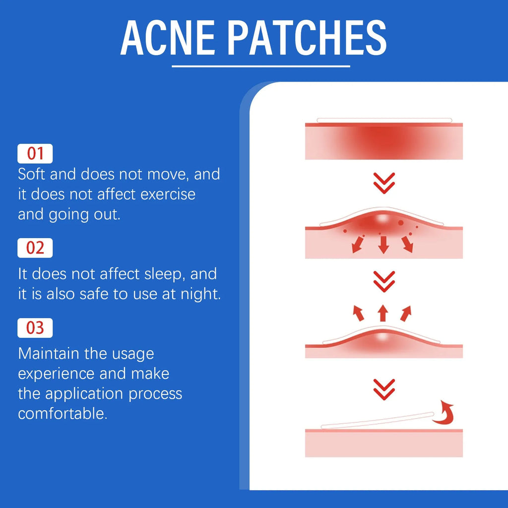 216 hydrocolloid acne patches in packaging with tea tree oil and vitamin E formulation