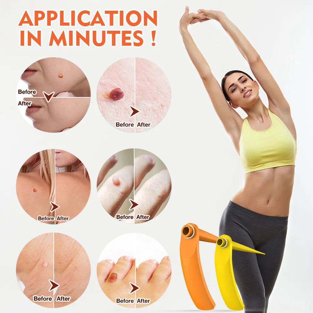 Orange yellow manual mole remover tool with metal cones, assorted rubber rings, alcohol swabs, and repair stickers on a white background.